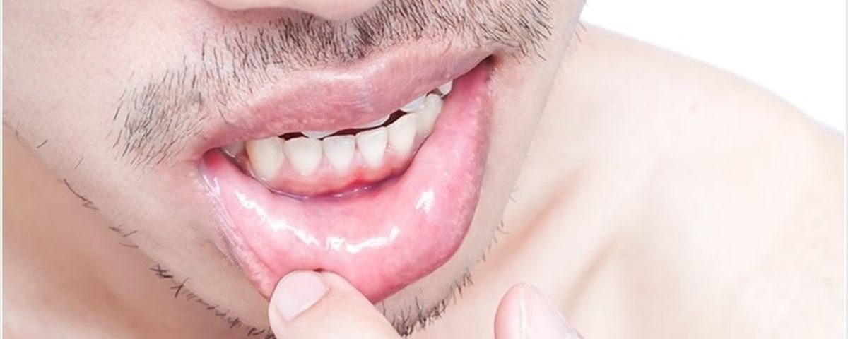 Herpes labial estres causas